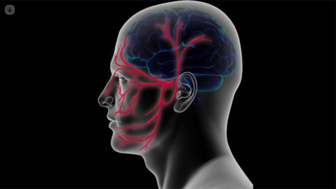 neuralgia del trigemino