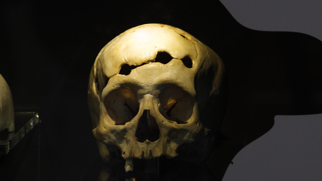 craneo trepanado